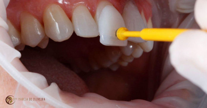 Lentes de contato dental