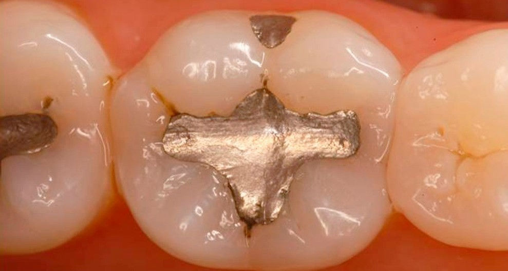 restauração metálica